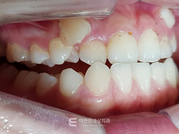 Kkachisan Station Orthodontic Clinic: A Severe Crowded Canine Case—Is Orthodontic Treatment Really Necessary? image 3