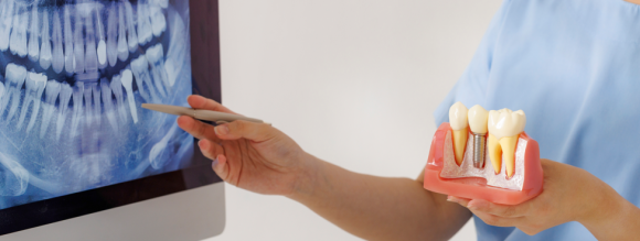 임플란트 식립후 식사, 음주, 흡연 주의사항 안내 관련 이미지 6