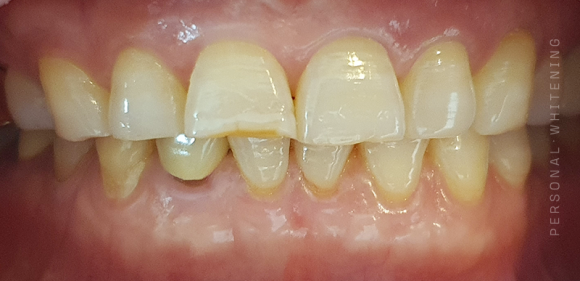 Hwagok Station Dental Clinic: Why Teeth Whitening Can Also Help People in Their 50s image 4