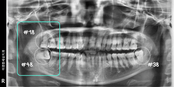 화곡역사랑니 신경 손상 가능성 있어도 대학병원 안 가도 되는 진짜 이유 관련 이미지 3