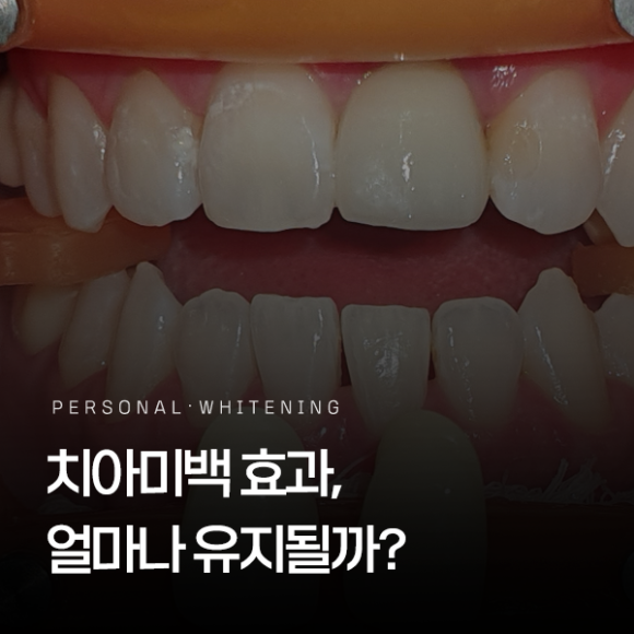 치아미백 효과 유지 기간 얼마나? 다시 누래질 수도 있나요? 관련 이미지 1