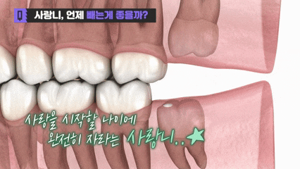 부천매복사랑니 40대보다 20대 때 뽑는 것이 좋은 이유 관련 이미지 2