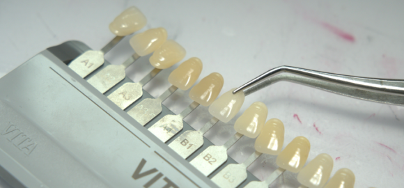 강서구 라미네이트 치과, 시술 전 후회하지 않으려면 꼭 확인하세요 관련 이미지 5