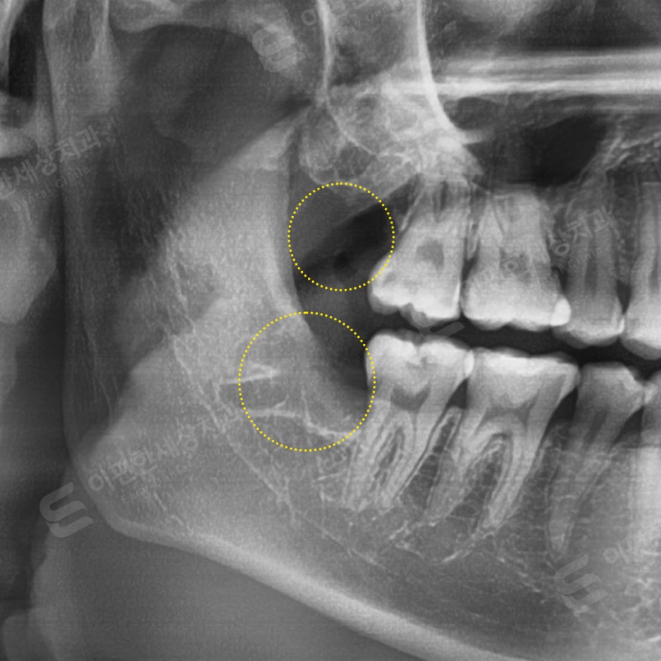 사랑니 발치 치과, 찾는 분들 읽어보세요. 관련 이미지 18
