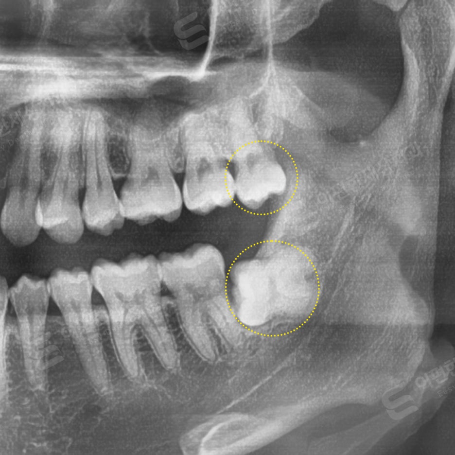 사랑니 발치 치과, 찾는 분들 읽어보세요. 관련 이미지 10