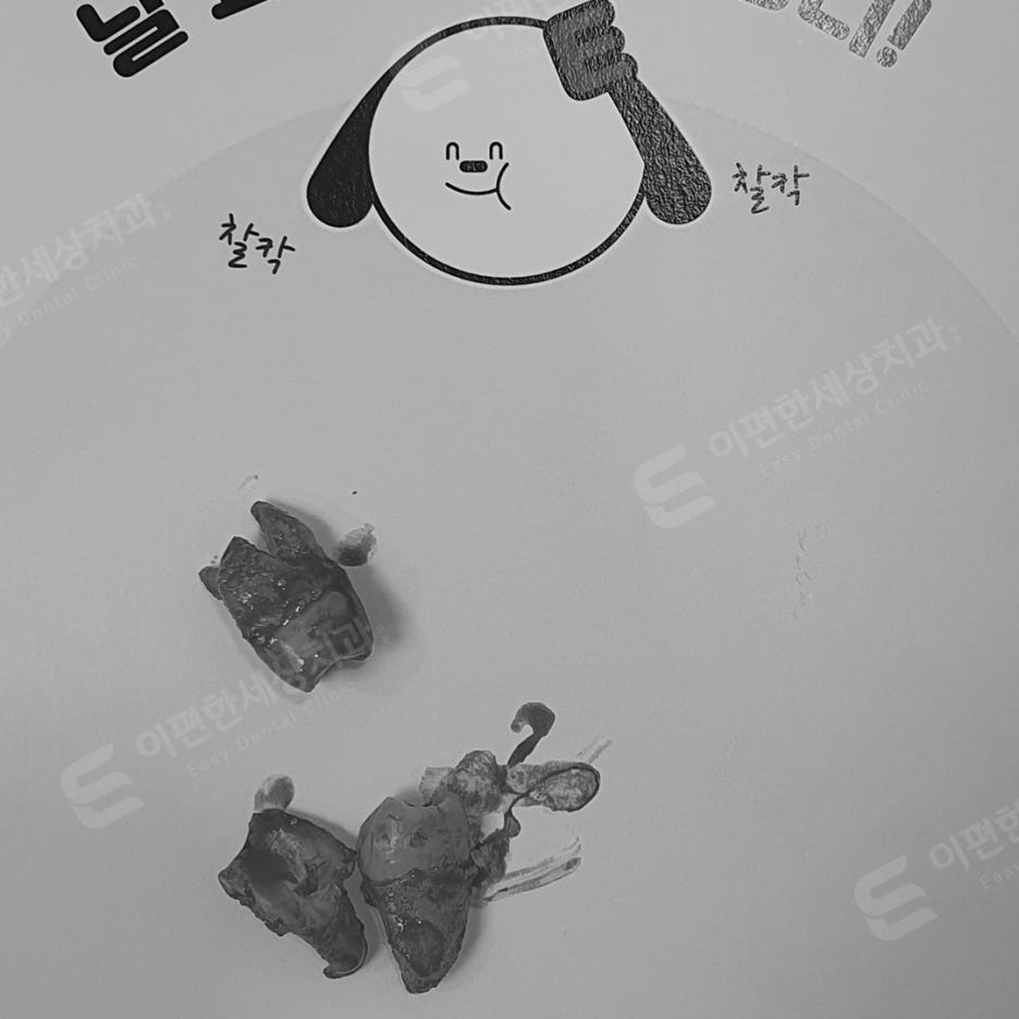 사랑니 발치 치과, 찾는 분들 읽어보세요. 관련 이미지 14