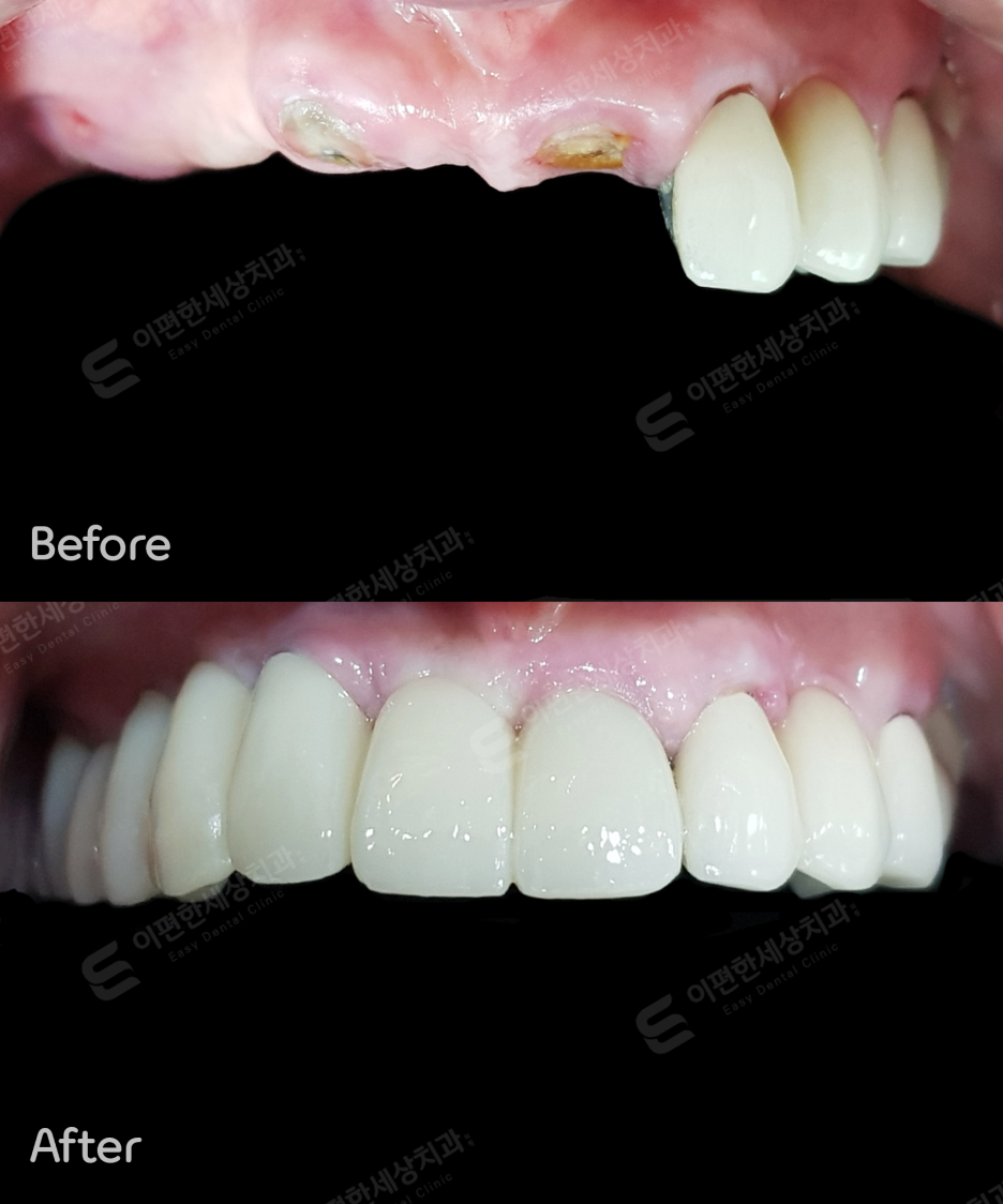 강서구임플란트, 치과 선택? 고민된다면 읽어보세요. 관련 이미지 7