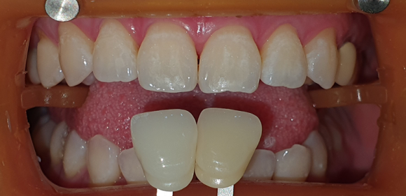 White Spots and Blotches After Teeth Whitening: Was the Treatment Done Incorrectly? image 4