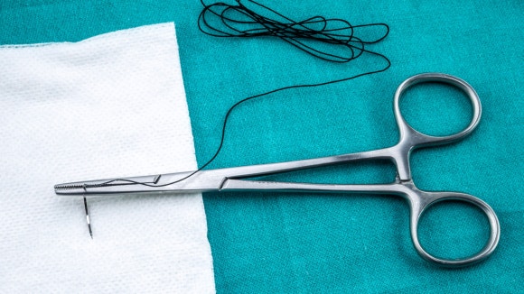 화곡동매복 사랑니 실밥, 중요한 이유는? 관련 이미지 3