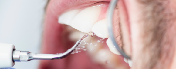 스케일링 후 이시림, 출혈 나타나는 이유는? 관련 이미지 1