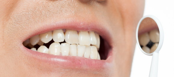 잇몸 벗겨짐, 그냥 둬도 괜찮을까요? 관련 이미지 2