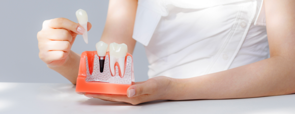 임플란트 식립후 식사, 음주, 흡연 주의사항 안내 관련 이미지 1