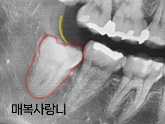 화곡사랑니, 빨리 뽑아야 이득인 이유 관련 이미지 5