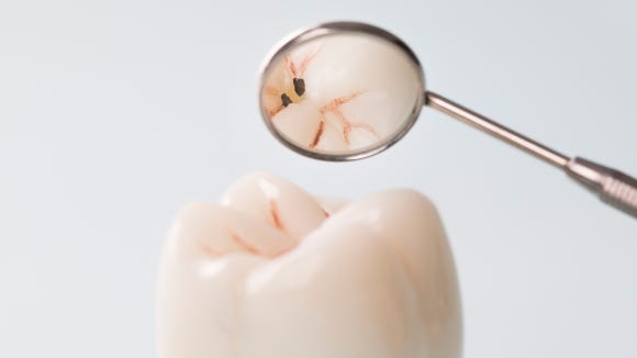 레진 인레이 차이 어떤 기준으로 선택해야 할까요? 관련 이미지 1