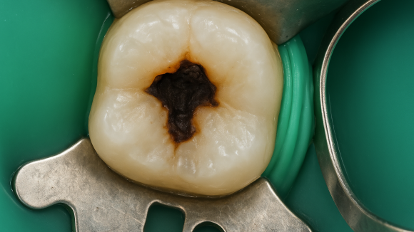 화곡동일요일치과, 구강검진을 미루면 안 되는 이유 관련 이미지 3