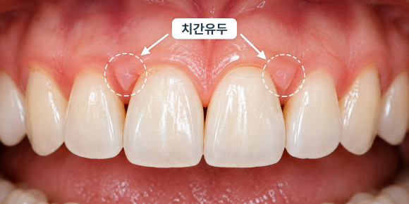 치아 사이 검은 점, 블랙 트라이앵글 왜 생기는 걸까요? 치료법은? 관련 이미지 2