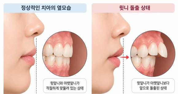 개화산역교정치과 과개교합과 윗니 돌출의 차이점은 무엇일까요? 관련 이미지 3