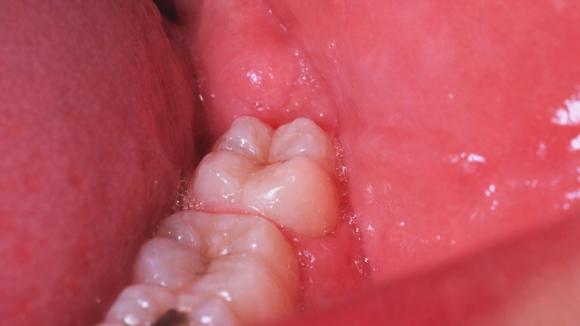 가양치과 사랑니 발치 때문에 고민이신가요? 관련 이미지 3