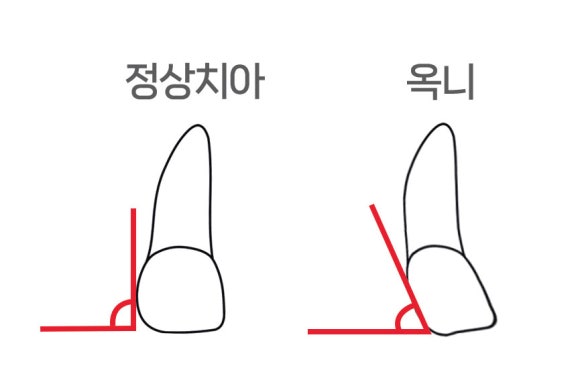 What Does “Okni” Mean, and Is Orthodontic Treatment Really Necessary? image 2
