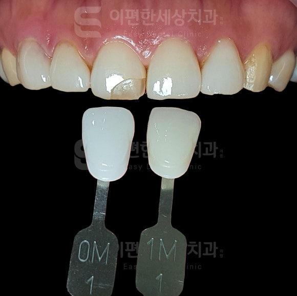 강서구 라미네이트 치과, 시술 전 후회하지 않으려면 꼭 확인하세요 관련 이미지 4