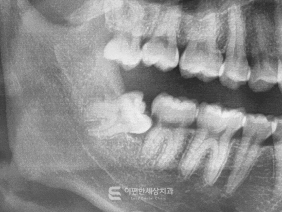화곡역 사랑니 발치 치과 꼭 대학병원이 아니라도 가능합니다 관련 이미지 3