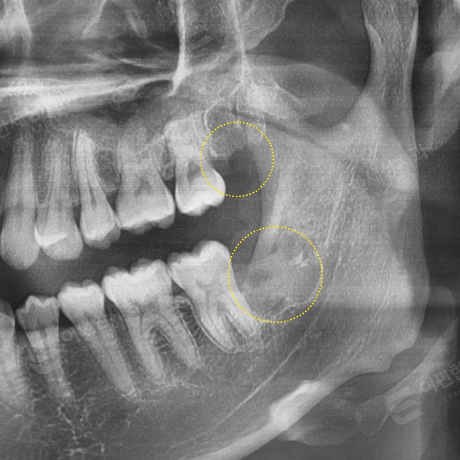사랑니 발치 치과, 찾는 분들 읽어보세요. 관련 이미지 12