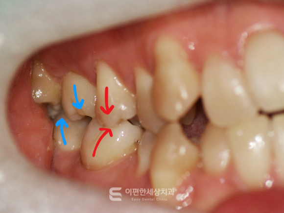 어금니 가위교합 왜 발생하는 걸까요? 치료해야 하는 이유는? 관련 이미지 2