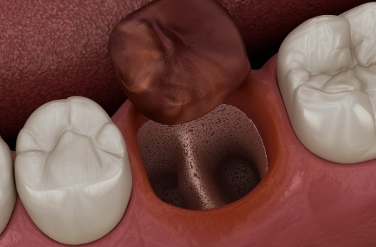 서울사랑니치과 부작용 걱정 없이 발치하고 싶다면 필독 관련 이미지 9