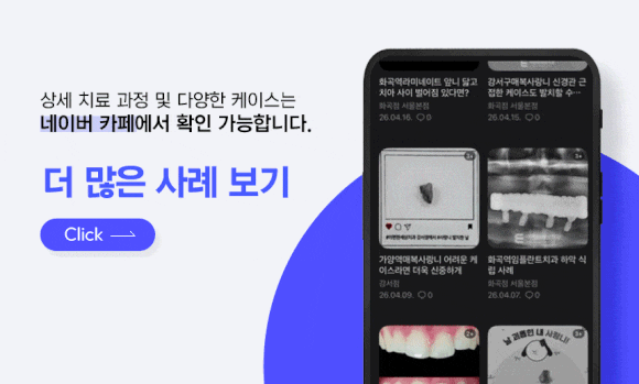 화곡동치과, 전문가 미백과 셀프 미백의 차이점은? 치과에서 해야 하는 이유 관련 이미지 6