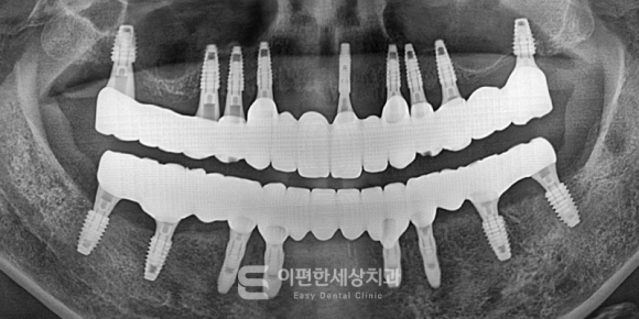 가양역임플란트 가격 비교 전에 먼저 확인해야 할 이것 관련 이미지 3