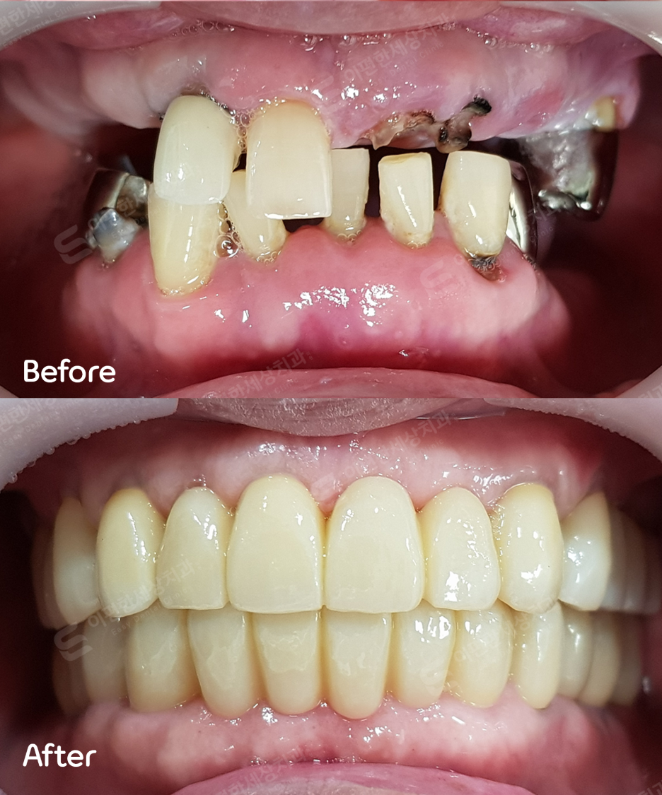 강서구임플란트, 치과 선택? 고민된다면 읽어보세요. 관련 이미지 8