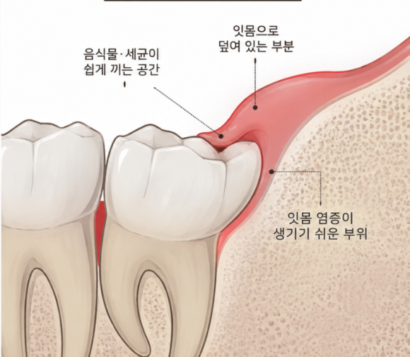 고촌치과, 사랑니 주위염/잇몸 부음이 반복되는데 가라앉으면 괜찮은 걸까요? 관련 이미지 2