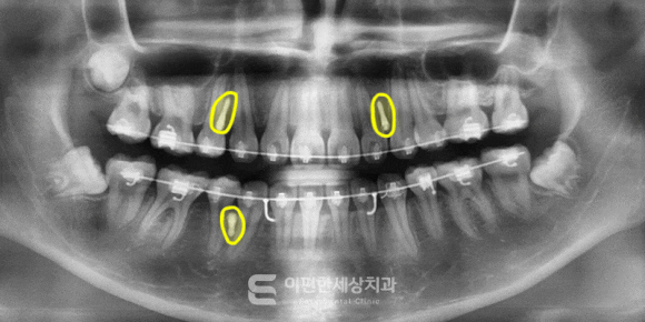 교정할 때 잇몸에 나사를 심는다고? 교정용 스크류가 무엇인지 아시나요? 관련 이미지 2