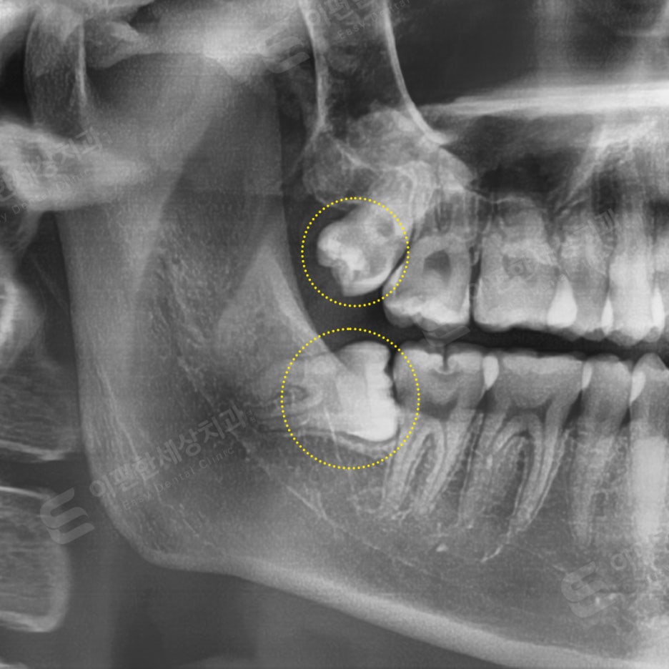 사랑니 발치 치과, 찾는 분들 읽어보세요. 관련 이미지 16
