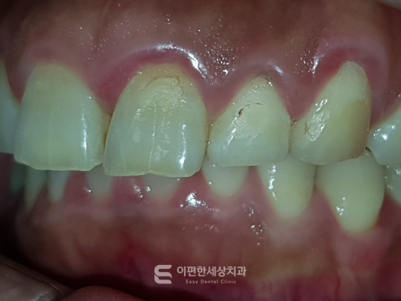 Hwagok Bon-dong Teeth Alignment: My Upper Teeth Cover My Lower Teeth! Can Orthodontic Treatment Improve an Overbite? image 3