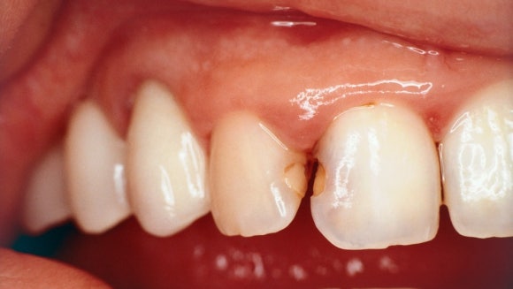 레진 인레이 차이 어떤 기준으로 선택해야 할까요? 관련 이미지 3