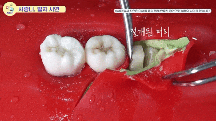 화곡역사랑니 신경 손상 가능성 있어도 대학병원 안 가도 되는 진짜 이유 관련 이미지 7