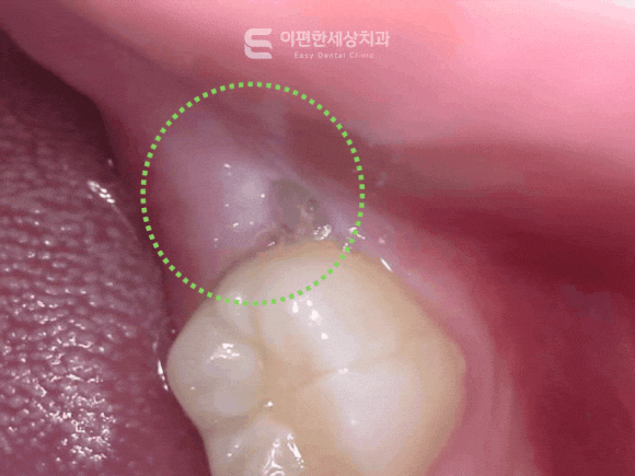 화곡역 사랑니 발치 치과 꼭 대학병원이 아니라도 가능합니다 관련 이미지 4