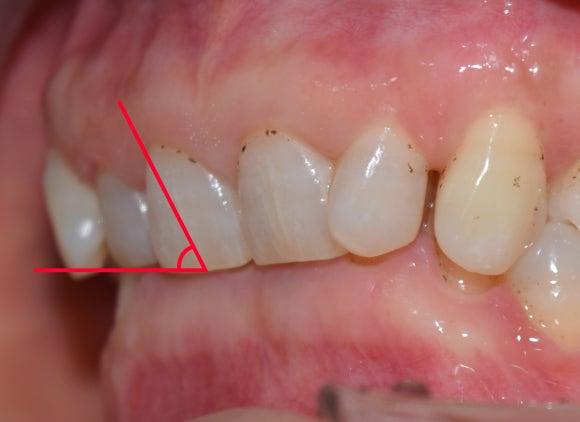 What Does “Okni” Mean, and Is Orthodontic Treatment Really Necessary? image 1