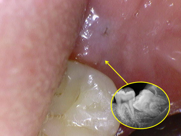 가양동사랑니 처음 뽑는다면? 유형별로 쉽게 이해해 보기 관련 이미지 3