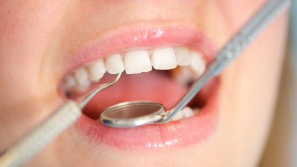 레진 인레이 차이 어떤 기준으로 선택해야 할까요? 관련 이미지 2