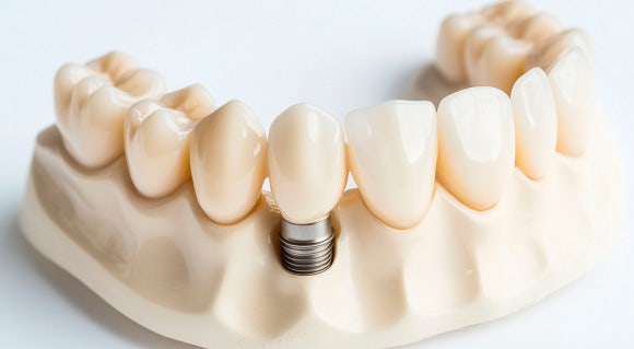 How Should You Choose a Gangseo Implant Dental Clinic? image 2