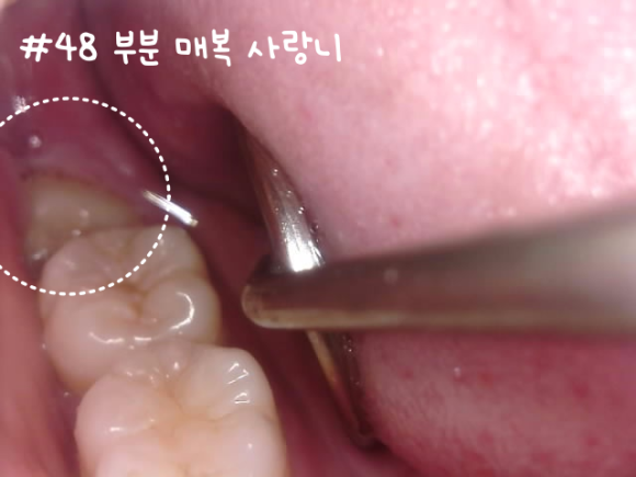 화곡역사랑니 신경 손상 가능성 있어도 대학병원 안 가도 되는 진짜 이유 관련 이미지 4