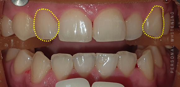 Can Yellowish Canines Be Improved with Teeth Whitening? image 5