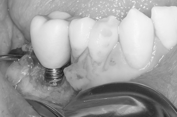 임플란트 전자담배, 언제부터 필수 있을까? 관련 이미지 2