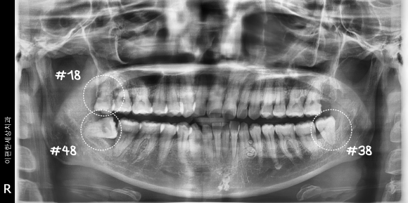 화곡역사랑니 신경 손상 가능성 있어도 대학병원 안 가도 되는 진짜 이유 관련 이미지 2