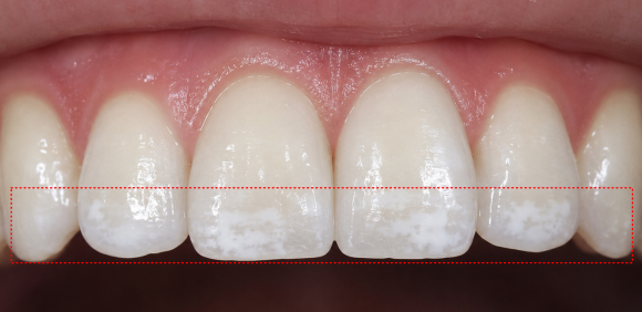White Spots and Blotches After Teeth Whitening: Was the Treatment Done Incorrectly? image 3