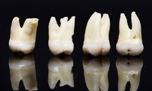 사랑니 온찜질, 냉찜질 순서가 궁금하다면?(발치 후 주의사항) 관련 이미지 5