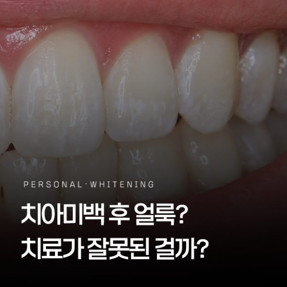 White Spots and Blotches After Teeth Whitening: Was the Treatment Done Incorrectly? image 1