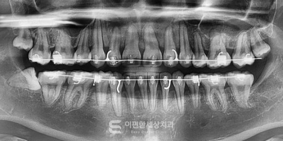 화곡역교정치과 덧니 교정 구강 위생 관리에 큰 영향을 미칩니다. 관련 이미지 3
